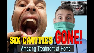 The Treatment for Tooth Decay that Reversed my 5 Cavities in 3 Months [upl. by Wulf]