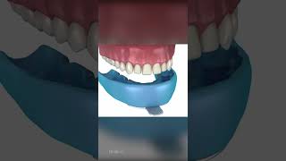 Veneers Dental Procedure [upl. by Eecrad]