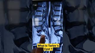 What Is Tarlov s Cyst  Dr Sai Chandra [upl. by Yrmac]