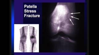 605 Accessory Ossicles vs Avulsion Fractures How can you tell [upl. by Cornish]