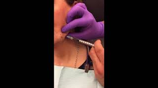 Surgery in a Syringe℠ Jowl Treatment with Kybella [upl. by Studner]