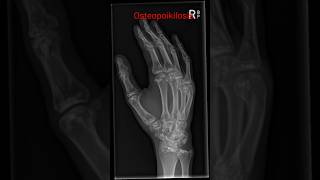 Hand xray  osteopoikilosis shorts handxray osteopoikilosis radiology [upl. by Tebazile]