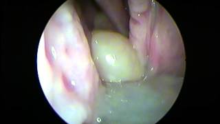 Left Antrochoanal polyp by Prof Dr Mohamed M ElSawy MD [upl. by Jareen]