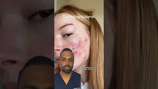 How does ACCUTANE work Dr Somji Explains [upl. by Ringsmuth]