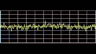 Emphysema  Rife Frequencies [upl. by Auqeenwahs908]