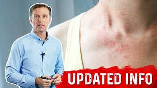 Keto Rash Is a Bile Deficiency – Bile Salts Dietary Fats and Keto Rash – Dr Berg [upl. by Anircam578]