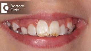 How do you treat Dental Fluorosis  Dr Aniruddha KB [upl. by Nnylatsirk]