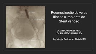 Recanalização de Veias Ilíacas e implante de Stent para tratar a Síndrome May Thurner  Cockett [upl. by Attelrahs136]