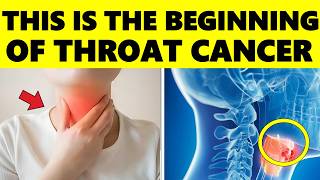 This is How Throat Cancer Starts And NO ONE Tells you – Signs and Symptoms of Throat Cancer [upl. by Walling323]