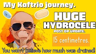 KaftrioTrikafta side effect  Unbelievably HUGE Hydrocele post operation update [upl. by Acisse]