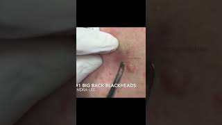 Dr Pimple Poppers Throwback Pops [upl. by Aissyla]