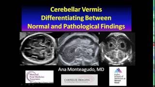 AIUM Webinar Cerebellar Vermis [upl. by Ymiaj]