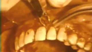 Gingivectomy Procedure to Eliminate Suprabony Pockets [upl. by Munson227]