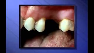 Partial Upper Denture  Miskin Ajax Dental [upl. by Akemed]