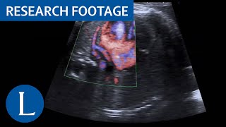 Standard fetal echocardiography in a fetus with abnormal pulmonary venous drainage Video 4 of 4 [upl. by Byers]