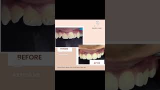 Braces Journey Experience the Before and After Magic braces [upl. by Dinerman]