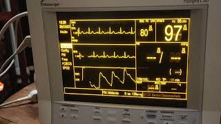 Monitor multiparametros Datascope Passport XG [upl. by Nedroj885]