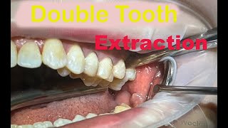 Teeth Extraction Procedure  Live Operation [upl. by Anomar]