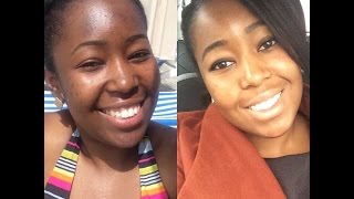 Clear Skin Journey Roaccutane and Kojic Acid Soap Results on Black Skin Before and After [upl. by Granese]