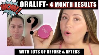 ORALIFT  MY 4 MONTH RESULTS  LOTS OF BEFORE amp AFTERS [upl. by Aerua]