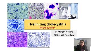 Hyalinizing Cholecystitis Rare histological variant [upl. by Eniretak515]