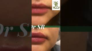 lip filler  correction of asymmetry [upl. by Luar269]