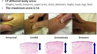 Webinar Diagnosis and Early Management of Scleroderma with Dr Francisco Boin 2015 [upl. by Aker178]