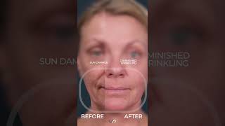 CO2 Laser Resurfacing for Facial Rejuvenation [upl. by Ecirtahs]