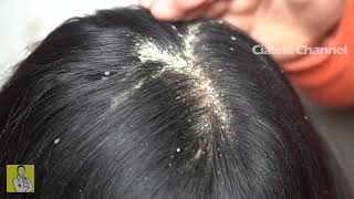 Satisfying Extremely Damaged Dandruff Scratching 1696 [upl. by Matty]