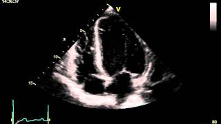 HYPERTENSIVE CARDIOMYOPATHY [upl. by Risser]