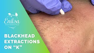 Blackhead Extrations on quotKquot  Hes back [upl. by Nigam]