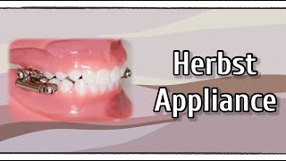 Herbst Appliance [upl. by Sell235]