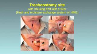 Rescue Breathing for Laryngectomees and Neck Breathers [upl. by Eioj767]