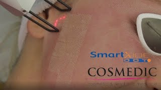 Cosmedic SmartXide Dot [upl. by Genet375]