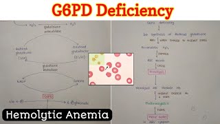 Glucose 6 Phosphate Dehydrogenase G6PD Deficiency  Hemolytic Anemia [upl. by Ryhpez659]