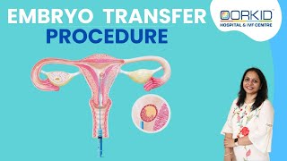 Embryo Transfer Process IVF Step Infertility and IVF Specialist in Valsad Bardoli Navsari Surat [upl. by Rebane]