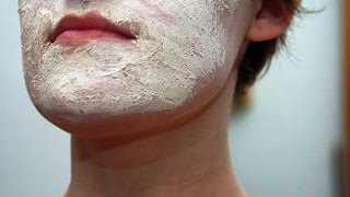 Face Eczema  Atopic Dermatitis  Eczema Dermatitis Rash Treatment [upl. by Prady680]