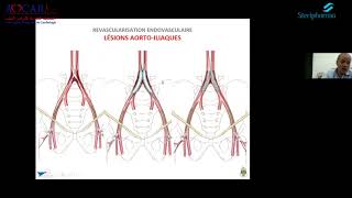 Vidéo Intégrale « Pathologie Vasculaire » [upl. by Relyk]