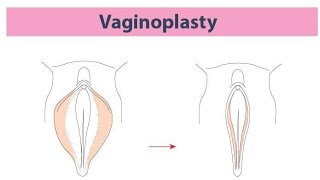 Vaginoplasty Surgery A StepbyStep Look into Vaginal Reconstruction [upl. by Marcellus]