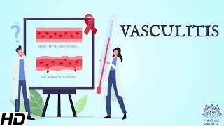 Vasculitis Everything You Need To Know [upl. by Natiha]