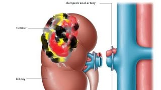 Radical NephrectomyUrology Dept [upl. by Urana]