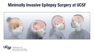 Minimally Invasive Epilepsy Surgery at UCSF  Edward Chang MD [upl. by Ahmed]