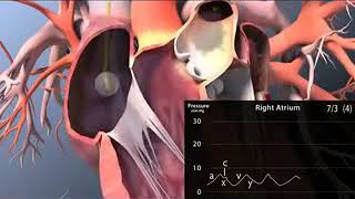 Catéter de Swan Ganz  Video de la NEJM [upl. by Eonak]