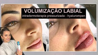 Intradermoterapia Pressurizada Hyaluronpen Volumização Labial Bruna Pilati [upl. by Desmond]