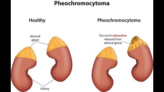 Pheochromocytoma  Simply Explained [upl. by Aerehs679]