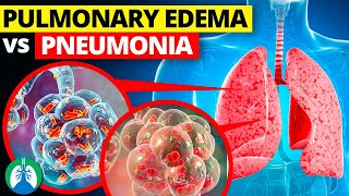 Pulmonary Edema vs Pneumonia [upl. by Eedak]