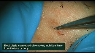 Electrolysis Ingrown Hair Removal  CLOSEUP  Here is how Electrolysis works  Jade Clinics [upl. by Tartan]