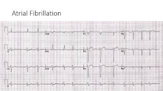 Atrial Fibrillation [upl. by Elleinahc]