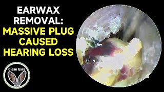 Cerumen Removal MASSIVE PLUG CAUSED HEARING LOSS [upl. by Eissert]