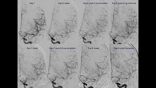 Vasospasm Combined endovascular treatment [upl. by Enileoj498]